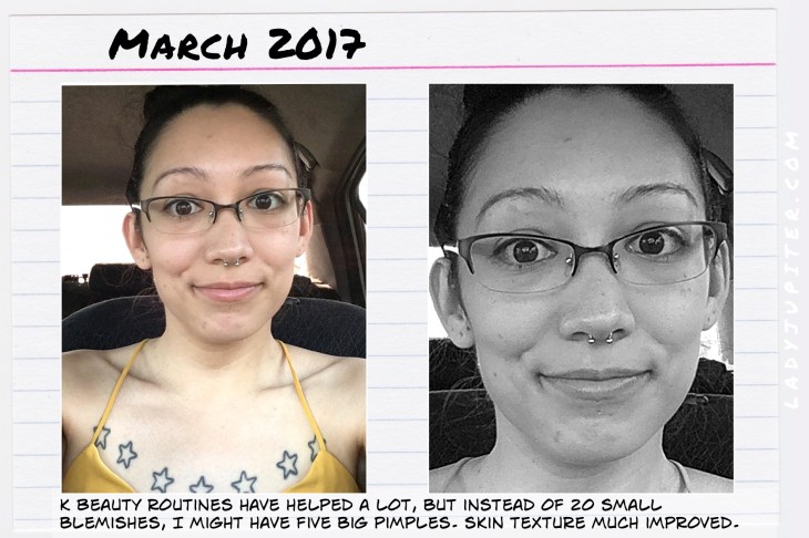 K Beauty routines helped pimple prevention - took a while, but worth the wait.