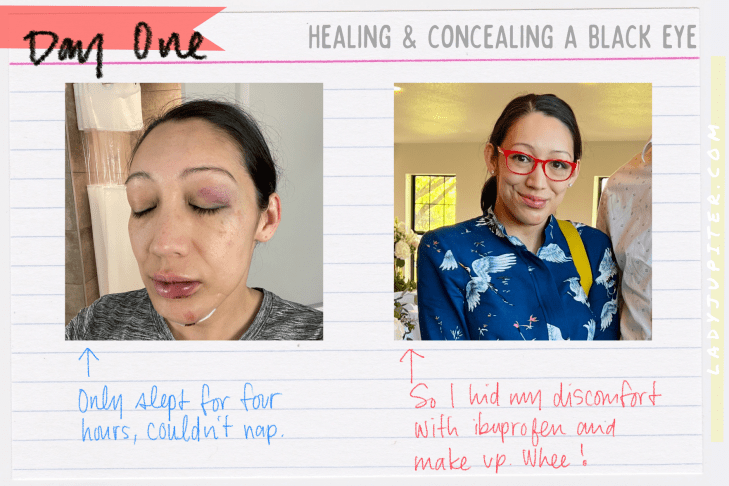It's not often that I earn a black eye, but I tempted gravity and lost. What's a gal to do? Heal, conceal, and share photos! #LadyJupiter #GravityHurts #EmergencyRoom #Stitches #FatLip #cleanCTscan #healing #JustAddTime