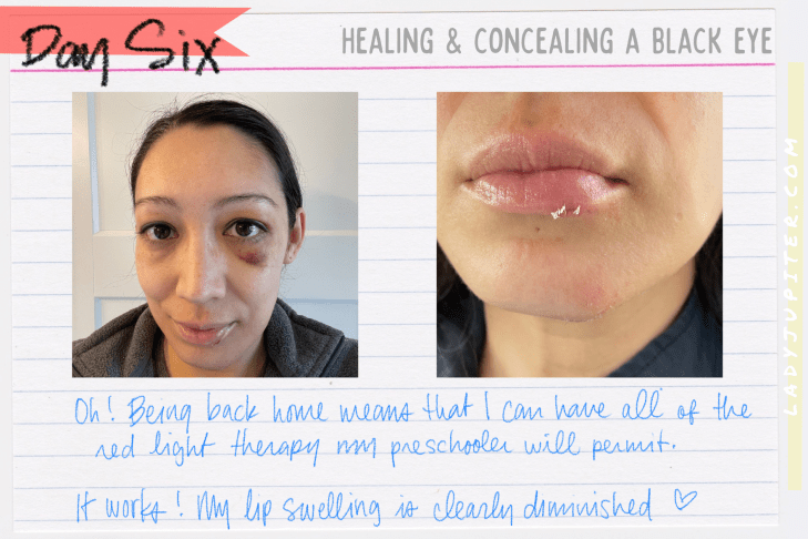 It's not often that I earn a black eye, but I tempted gravity and lost. What's a gal to do? Heal, conceal, and share photos! #LadyJupiter #GravityHurts #EmergencyRoom #Stitches #FatLip #cleanCTscan #healing #JustAddTime