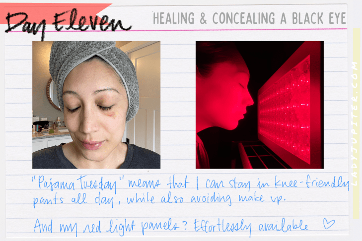 It's not often that I earn a black eye, but I tempted gravity and lost. What's a gal to do? Heal, conceal, and share photos! #LadyJupiter #GravityHurts #EmergencyRoom #Stitches #FatLip #cleanCTscan #healing #JustAddTime