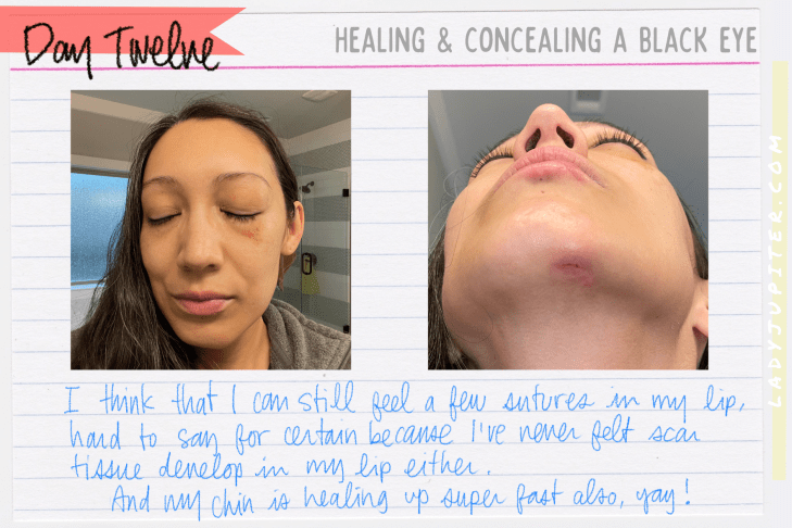 It's not often that I earn a black eye, but I tempted gravity and lost. What's a gal to do? Heal, conceal, and share photos! #LadyJupiter #GravityHurts #EmergencyRoom #Stitches #FatLip #cleanCTscan #healing #JustAddTime