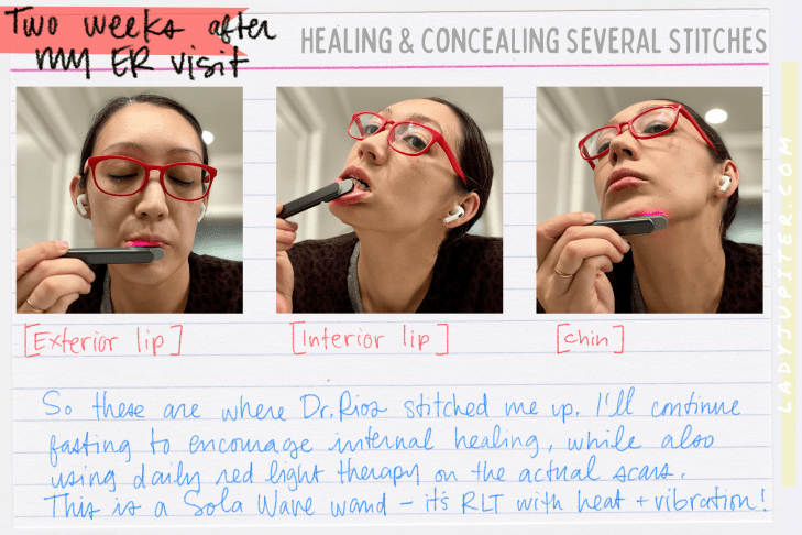 It's not often that I earn a black eye, but I tempted gravity and lost. What's a gal to do? Heal, conceal, and share photos! #LadyJupiter #GravityHurts #EmergencyRoom #Stitches #FatLip #cleanCTscan #healing #JustAddTime