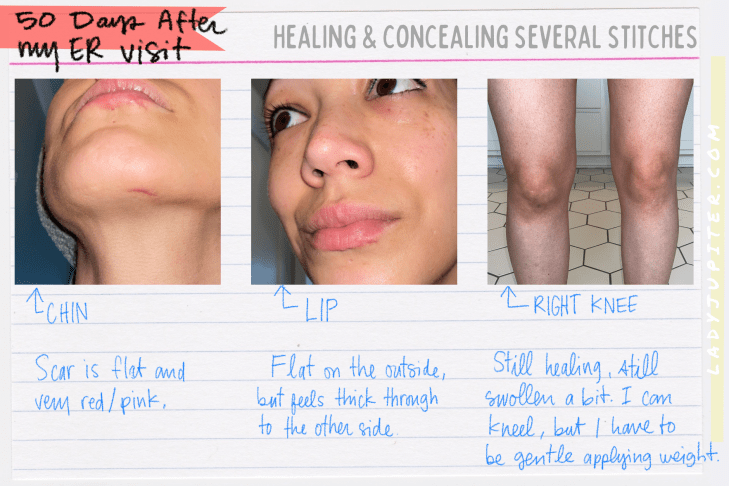 Healing continues! Only 50 days since my emergency stitches, and I'm so much better. #LadyJupiter #healing #stitches #FastingForHealing #TrustTheProcess